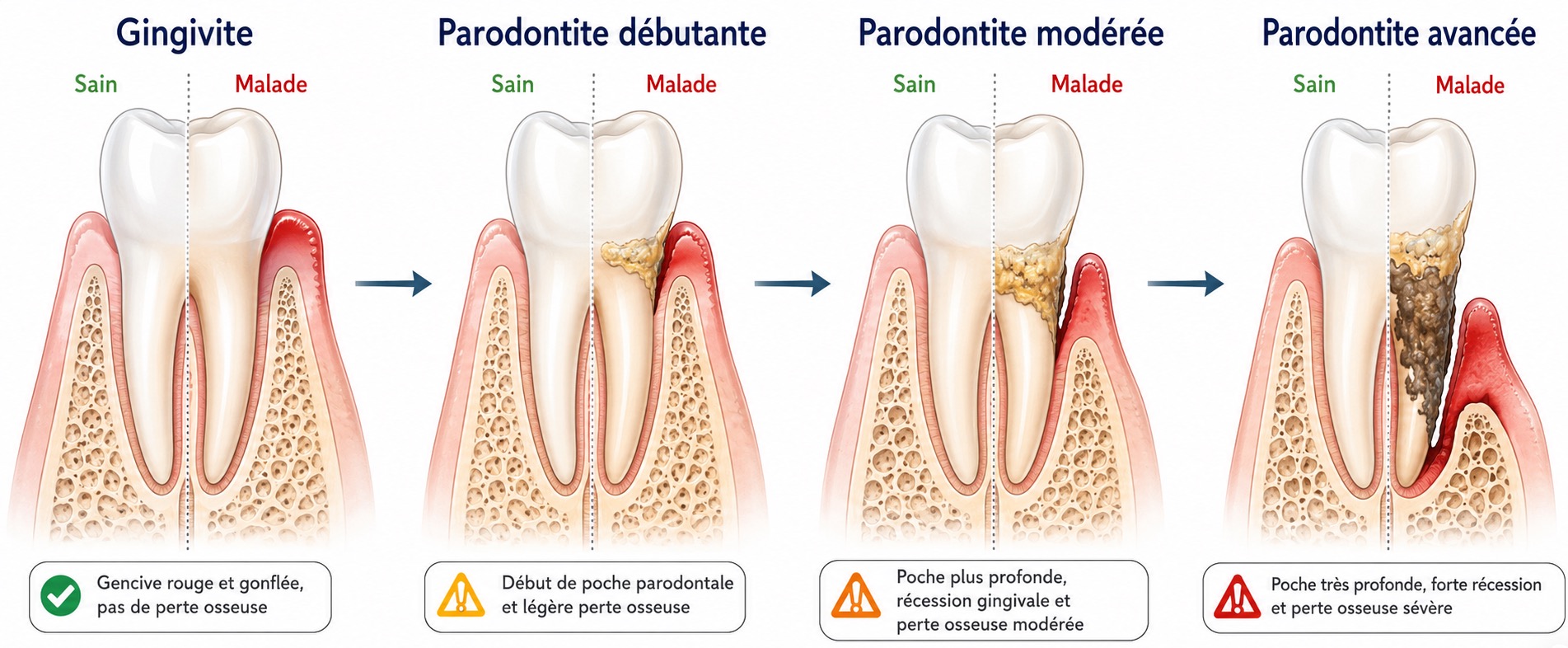 Infographie des stades de la maladie parodontale : gingivite, parodontite débutante, modérée et avancée, montrant la progression de la perte osseuse et de la récession gingivale.